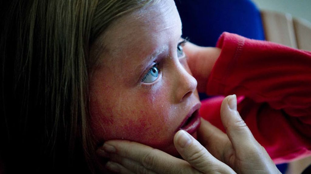 Piel enrojecida e irritada