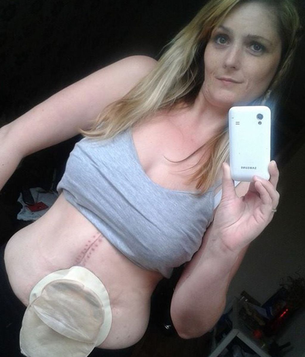 Cientos de enfermos de Crohn dejan de esconder sus fotos de resíduos gracias a la iniciativa de una modelo