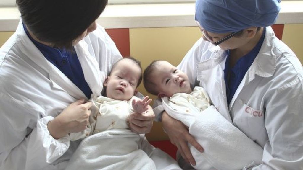 Separan con éxito a dos siamesas chinas unidas por el tronco