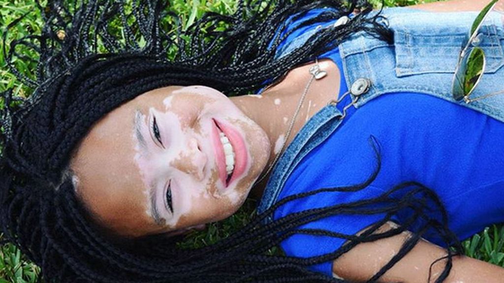La niña con vitiligo que ha revolucionado las redes sociales