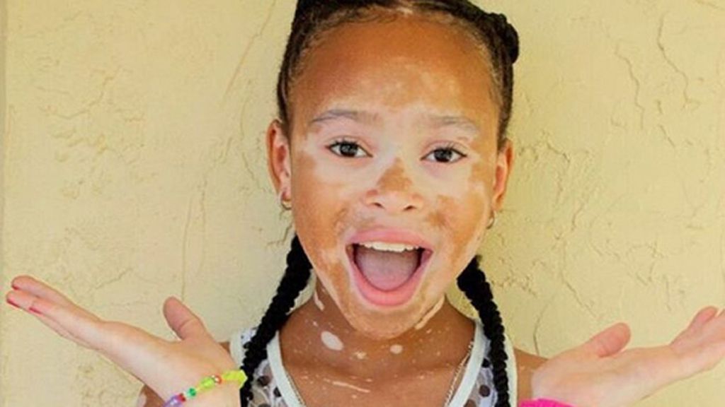 La niña con vitiligo que ha revolucionado las redes sociales