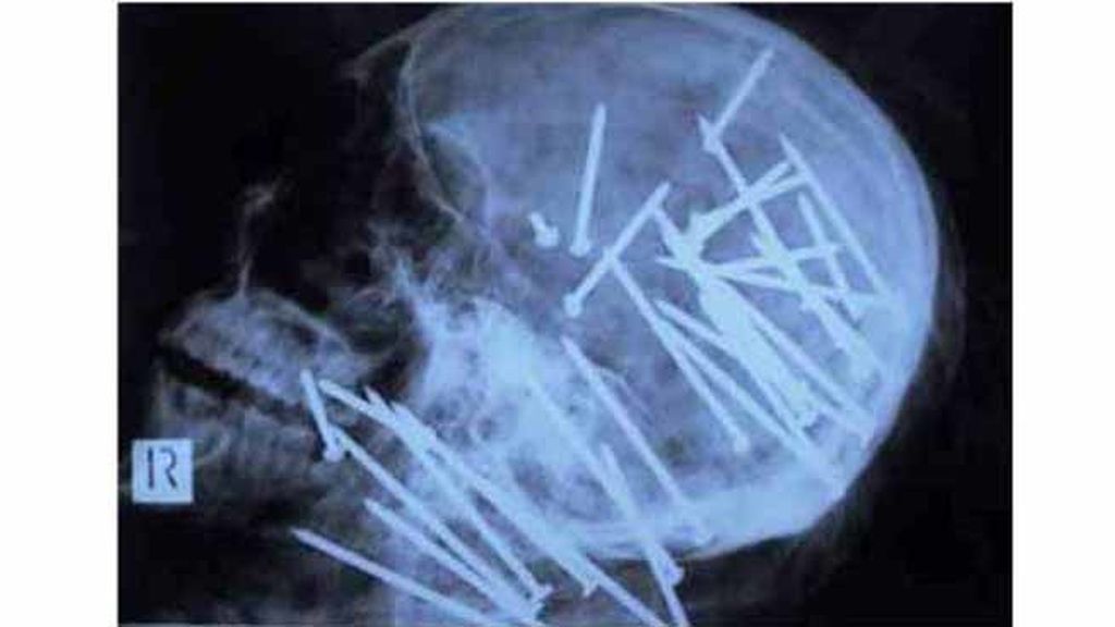 Objetos inesperados dentro del cuerpo