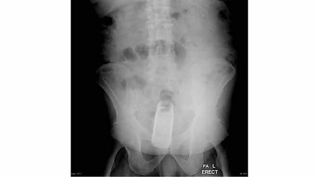 Objetos inesperados dentro del cuerpo