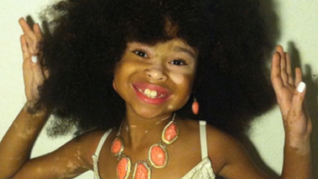 La niña con vitiligo que ha revolucionado las redes sociales