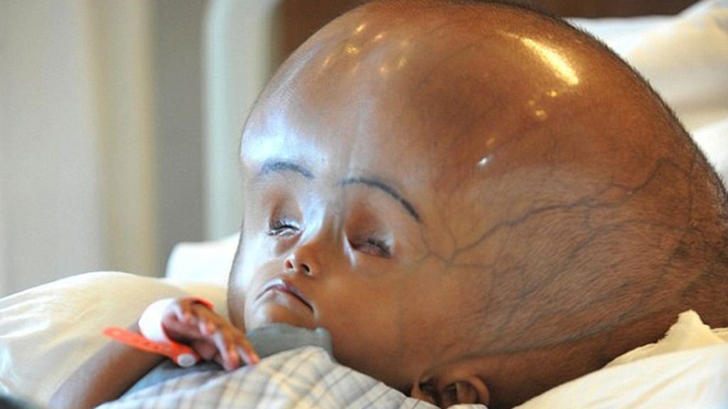 Una niña sobrevive a una operación para reducir el tamaño de su cabeza