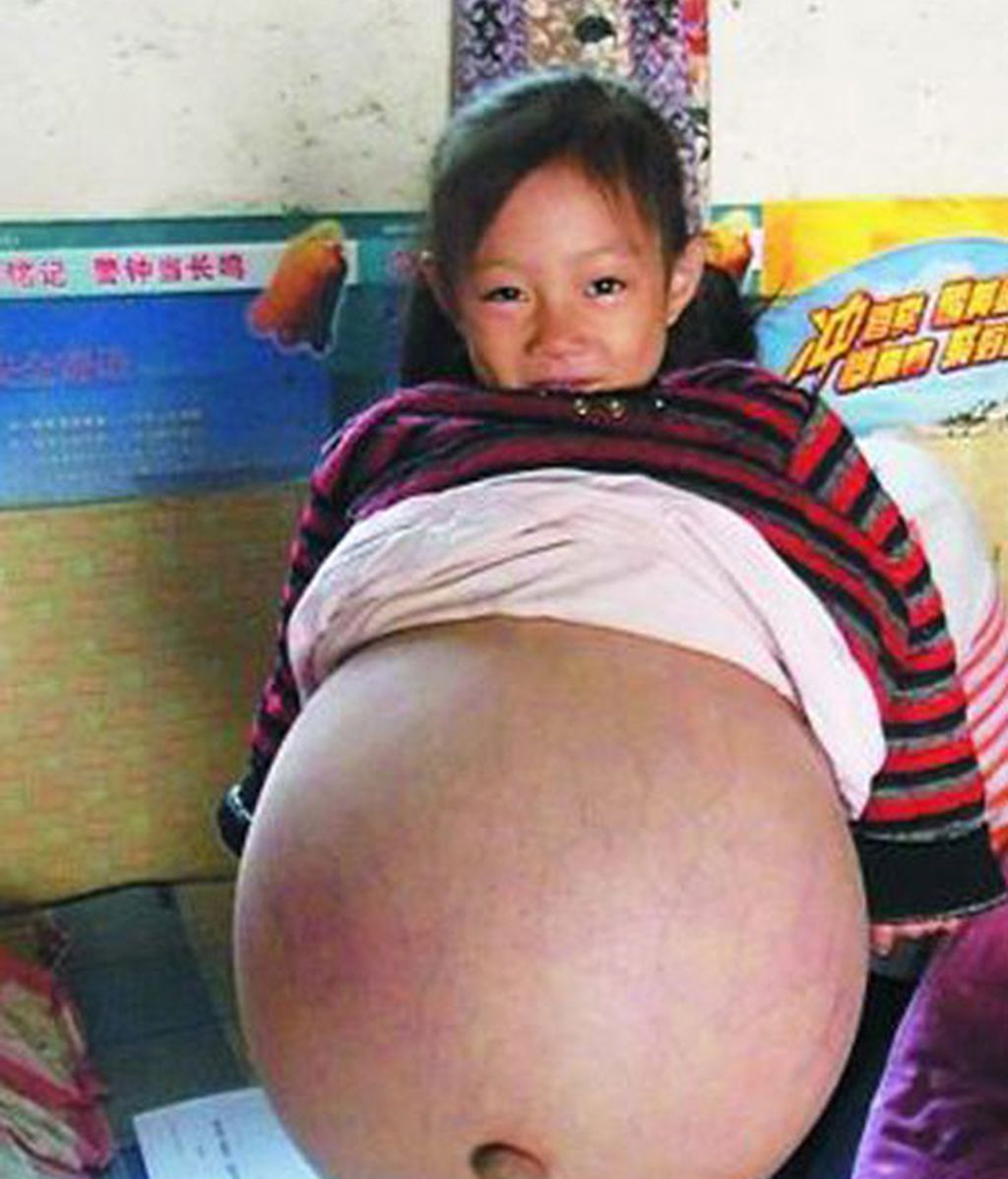 Padece una enfermedad que hincha su abdomen hasta límites extremos