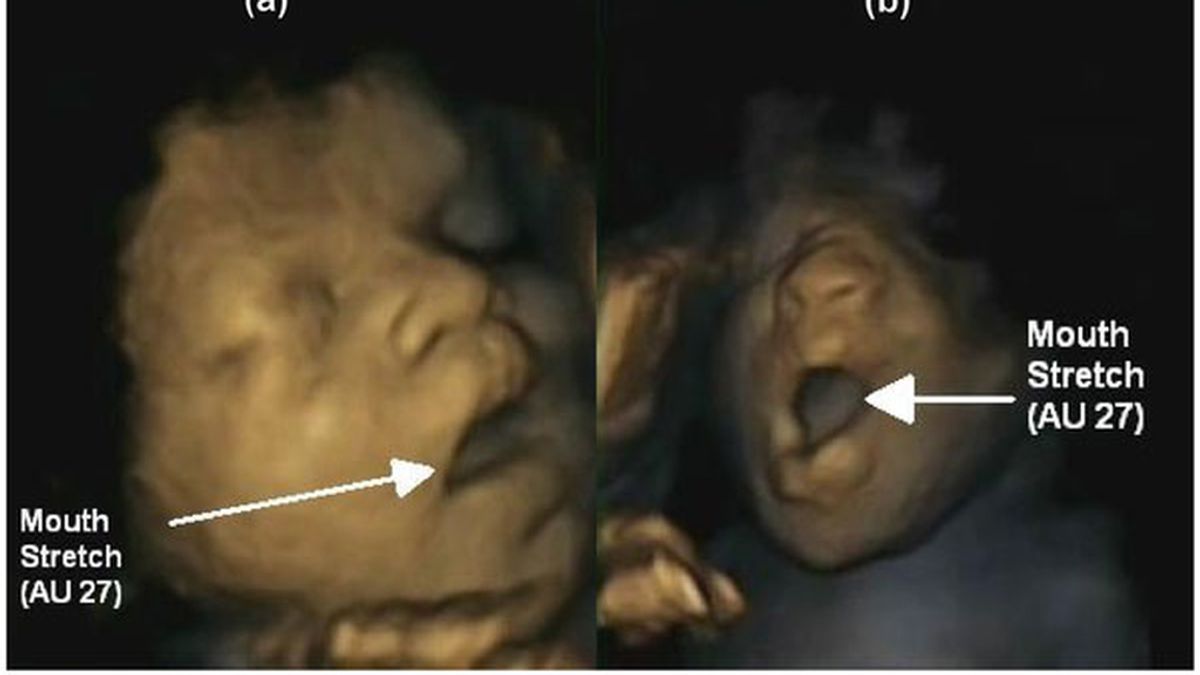 Imagen de un feto bostezando