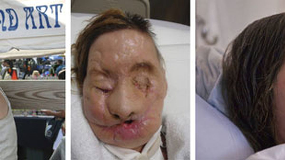 Carla ha recuperado su rostro gracias a un trasplante. Foto: EFE