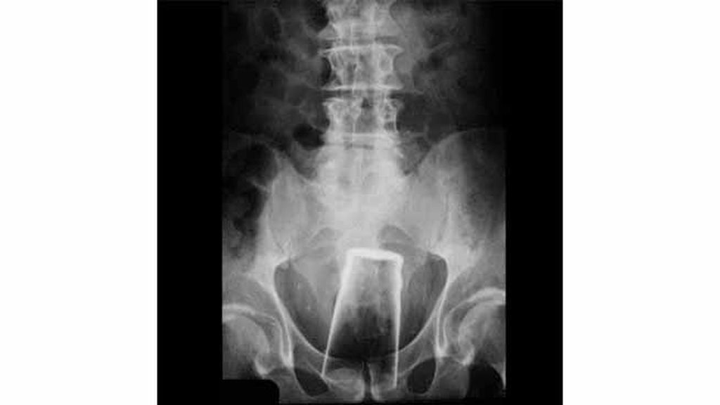 Objetos inesperados dentro del cuerpo