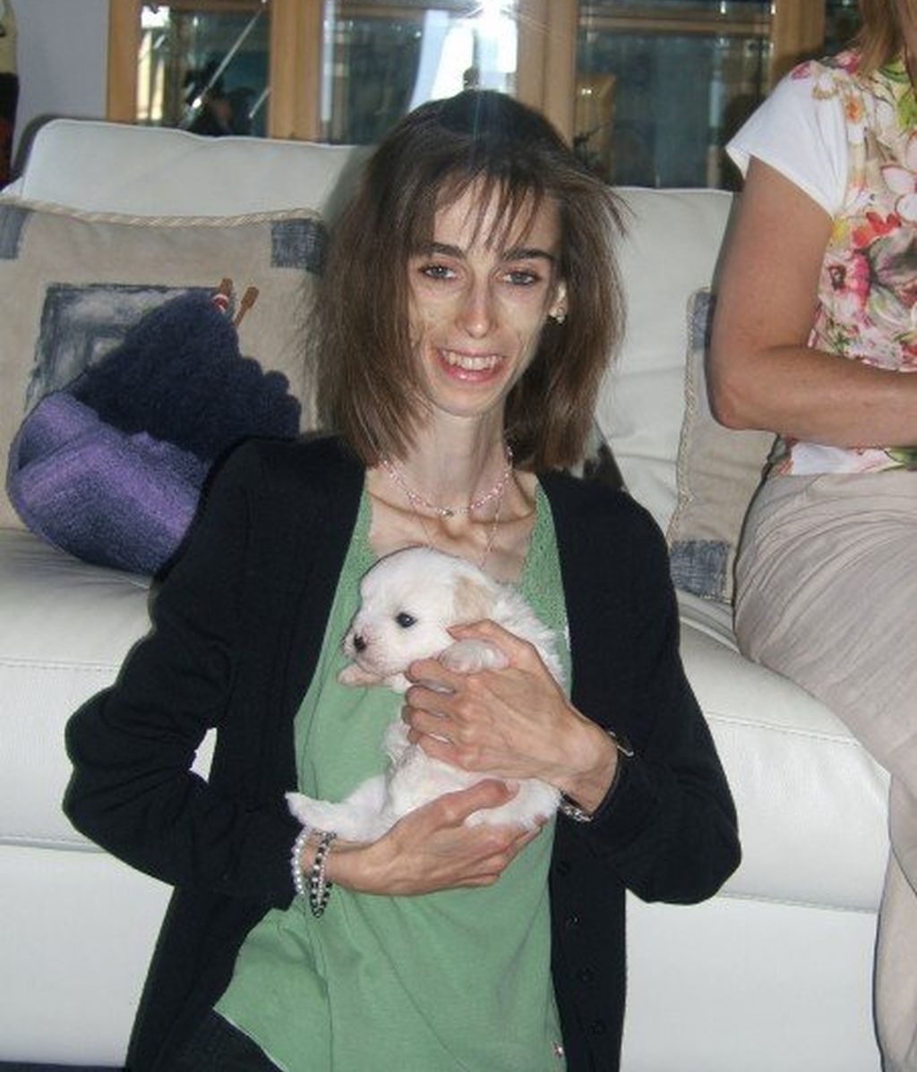 El peor caso de anorexia jamás visto