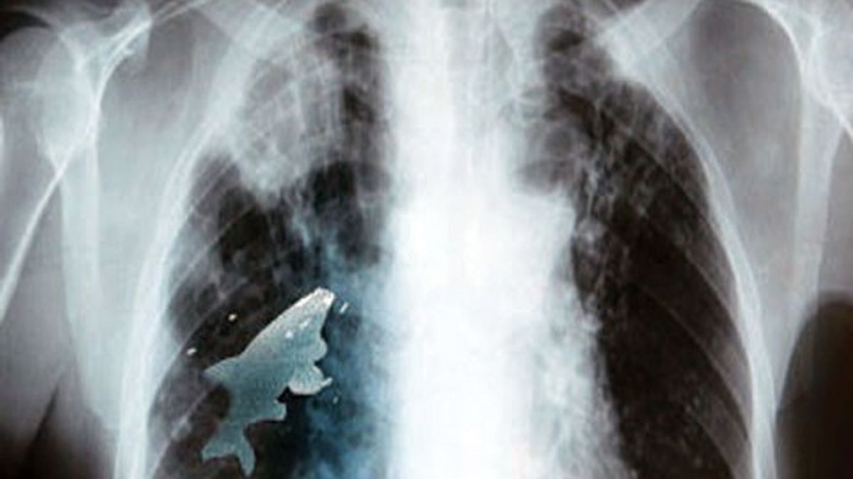 Pez vivo, pulmón, radiografía