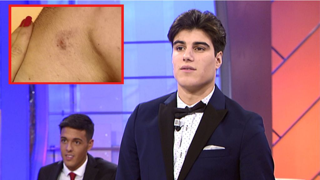 Julen enfadado por el chupetón: "Odio que me marquen"
