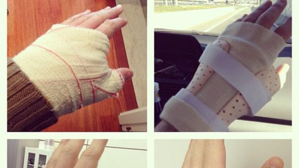 La evolución de la lesión en la mano de Iker Casillas La evolución de la lesión en la mano de Iker Casillas