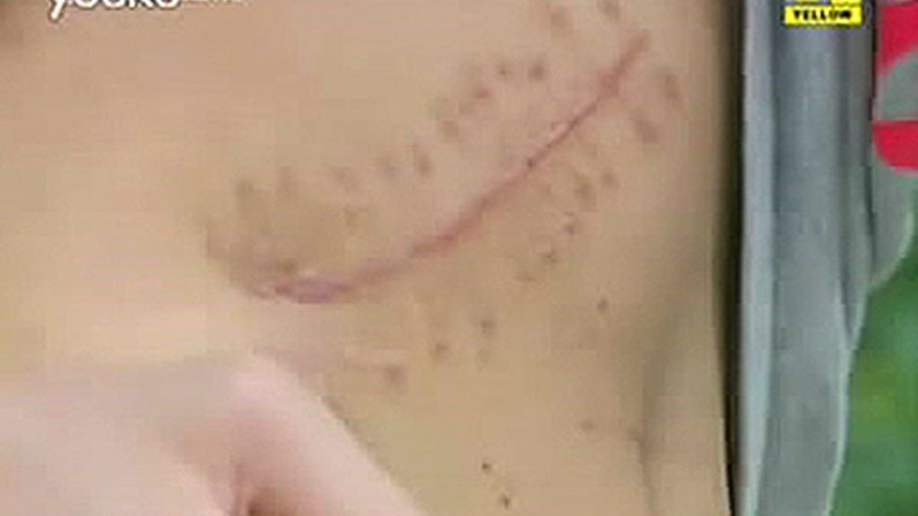 El joven chino mostró la cicatriz de la operación en la televisión de Shenzhen. El joven chino mostró la cicatriz de la operación en la televisión de Shenzhen.