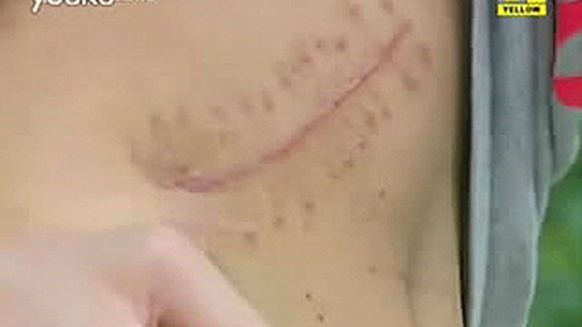 El joven chino mostró la cicatriz de la operación en la televisión de Shenzhen.