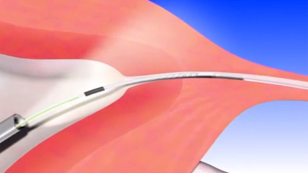 Perder el útero o las trompas por un método anticonceptivo