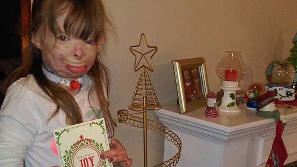 Safyre Terry, la niña con el 75% de su cuerpo quemado, cumple su deseo de Navidad