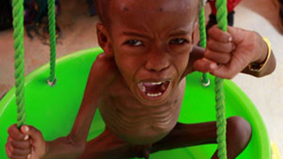 Una gran cantidad de niñoes están expuestos al cólera debido a la malnutrición FOTO: REUTERS
