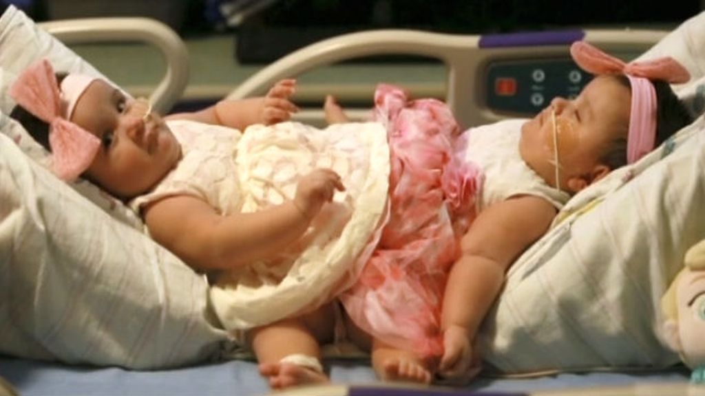 Separan con éxito a las siamesas nacidas en un parto de trillizas