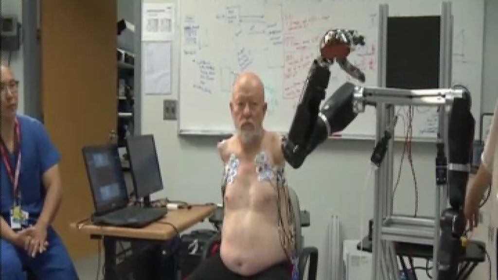 Crean unos brazos robotizados que usan el pensamiento de los pacientes