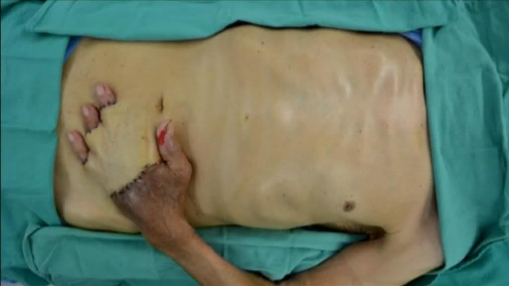 Tras un accidente, le implantan su mano en el abdomen y consigue salvarla