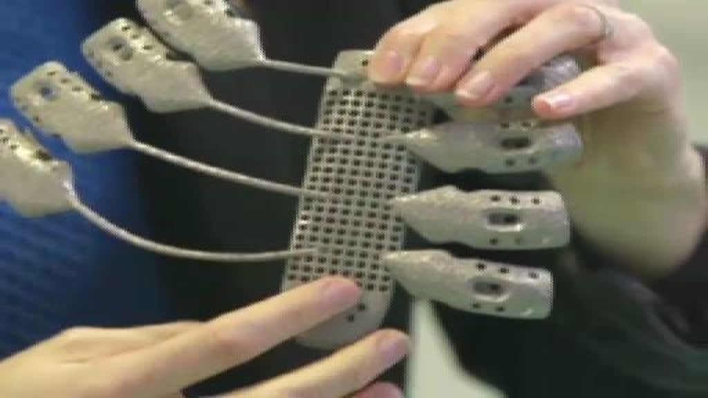 Un tórax a medida con una impresora 3D