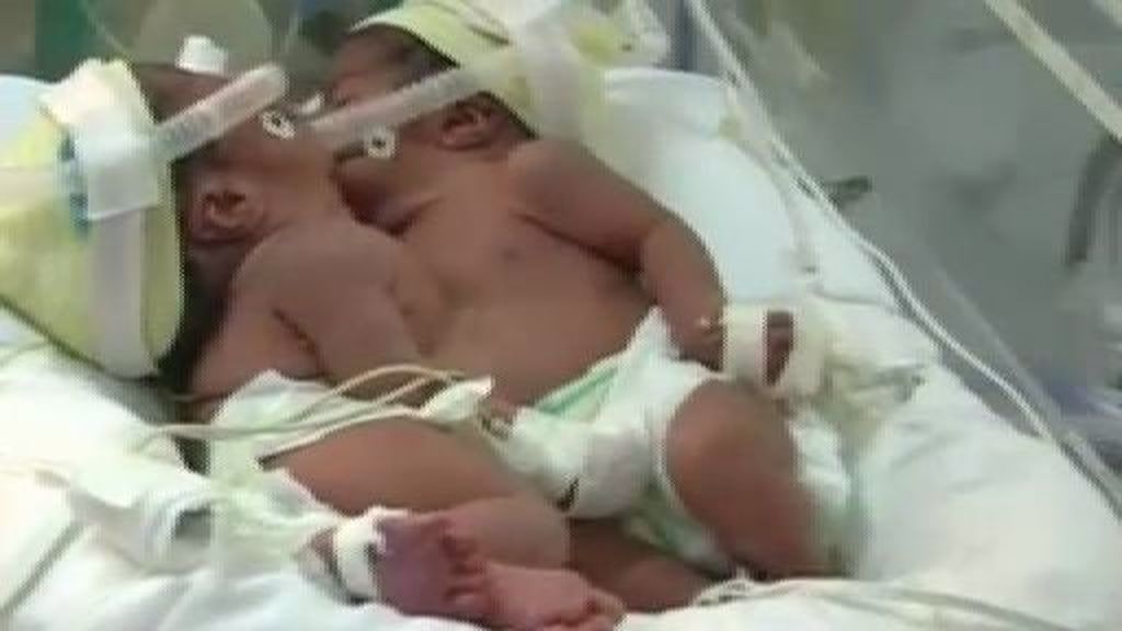 Nacen dos hermanas siamesas en Perú unidas por tórax y abdomen