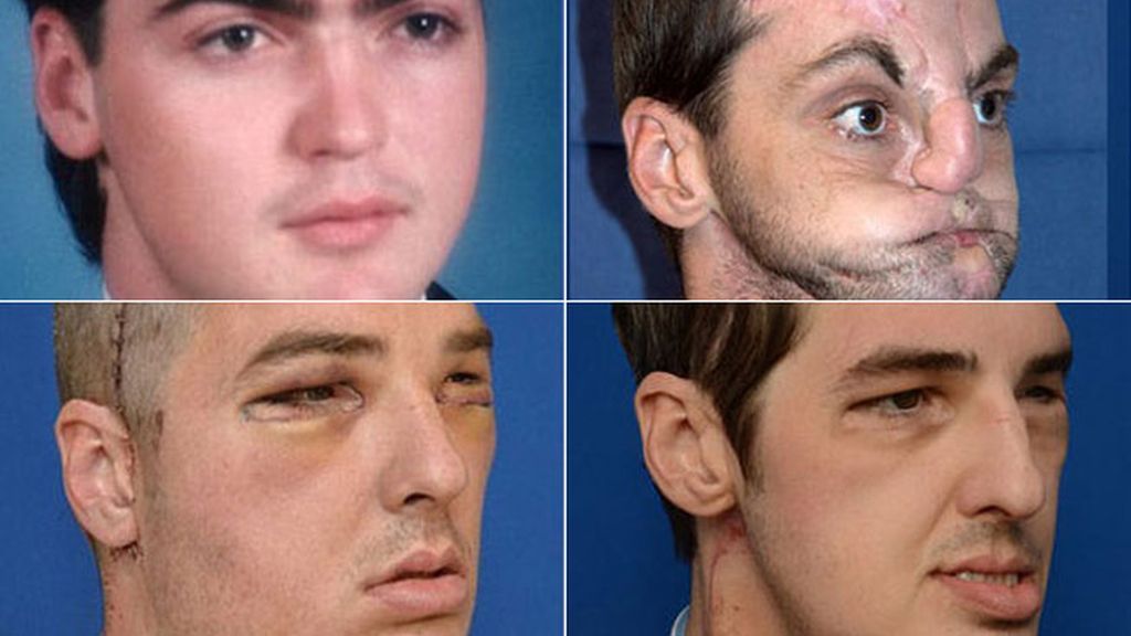 El antes y después de un trasplante de cara