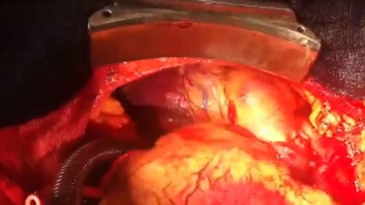 Imagen que muestra a los dos corazones latiendo simultáneamente en el pecho de Tyson Smith. Imagen que muestra a los dos corazones latiendo simultáneamente en el pecho de Tyson Smith.