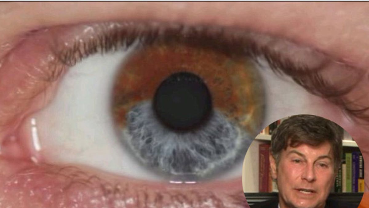 El doctor Gregg Homer, de California, ha desarrollado una técnica para poner azules los ojos marrones.