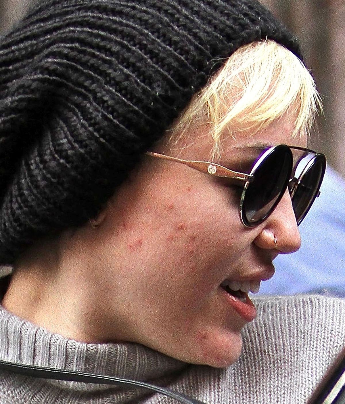Miley Cyrus no se libra del acné juvenil