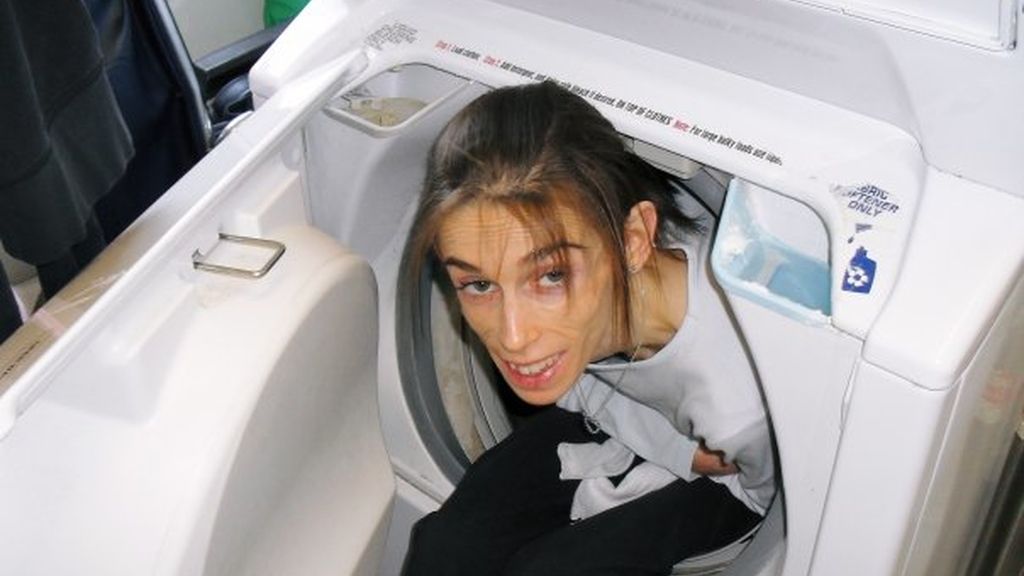 El peor caso de anorexia jamás visto