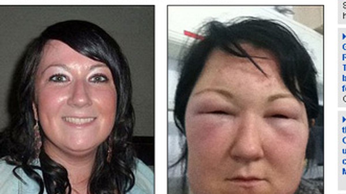 Mariade Kelly, de 29 años, terminó en Urgencias después de usar un tinte para el cabello que le provocó una grave reacción alérgica.