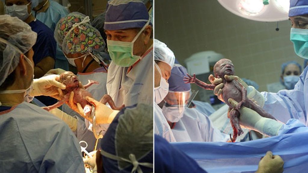 Momento en el que uno de los sixtillizos llega al mundo. Foto: Centro Médico Brookwood Momento en el que uno de los sixtillizos llega al mundo. Foto: Centro Médico Brookwood