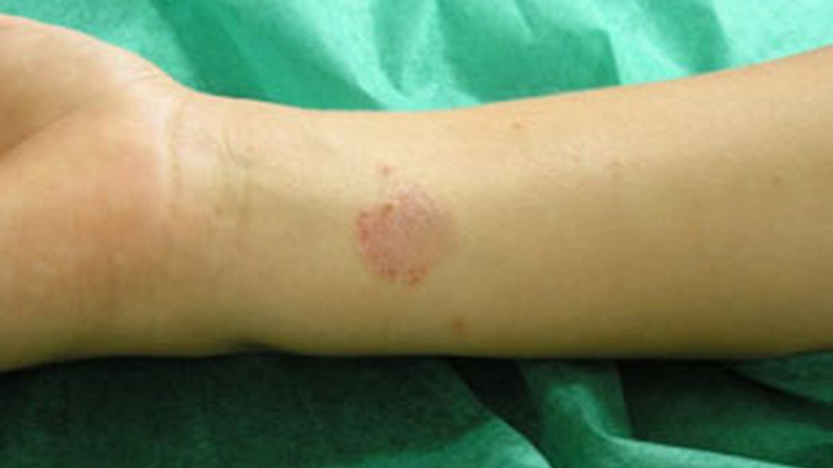 Un ejemplo de inflamación de la piel a causa de la tiña.