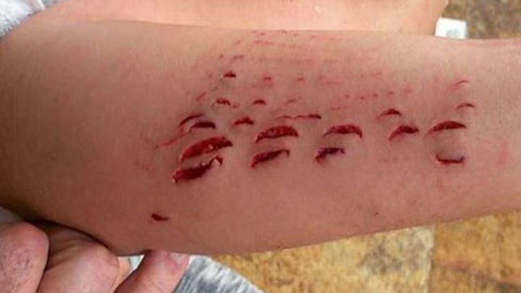 Una bañista es mordida por un tiburón en una playa de Canarias