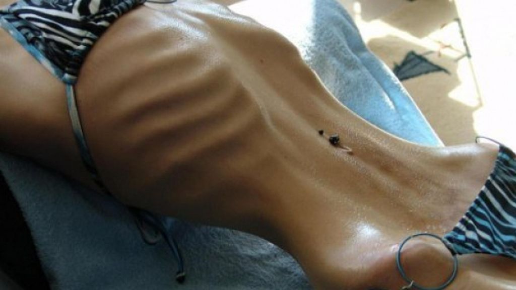 El peor caso de anorexia jamás visto