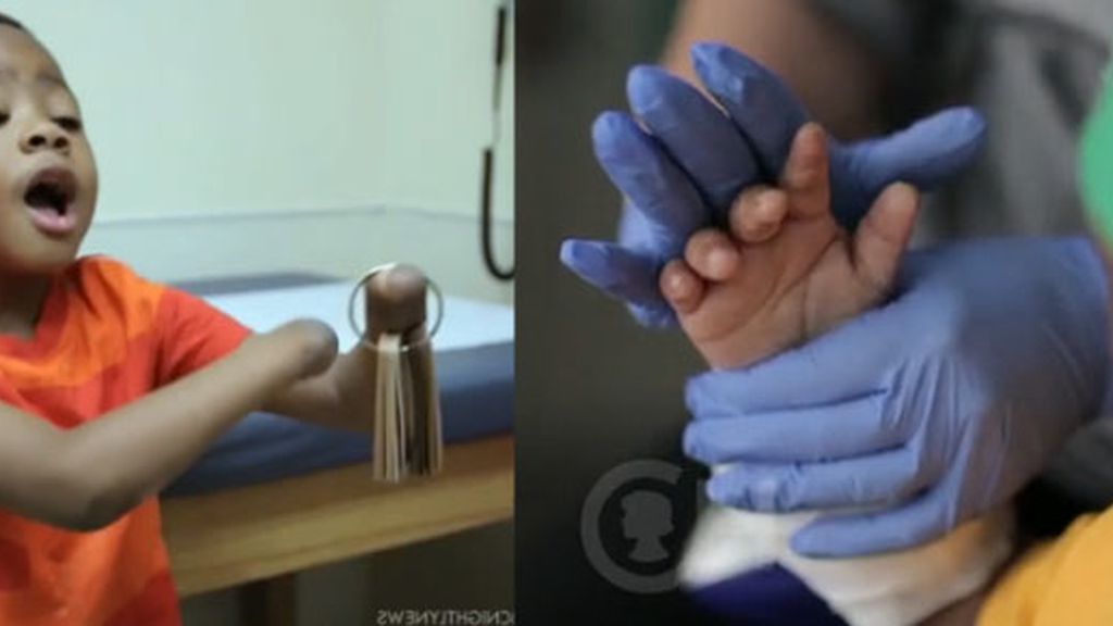 Realizan el primer doble trasplante de manos a un niño de 8 años