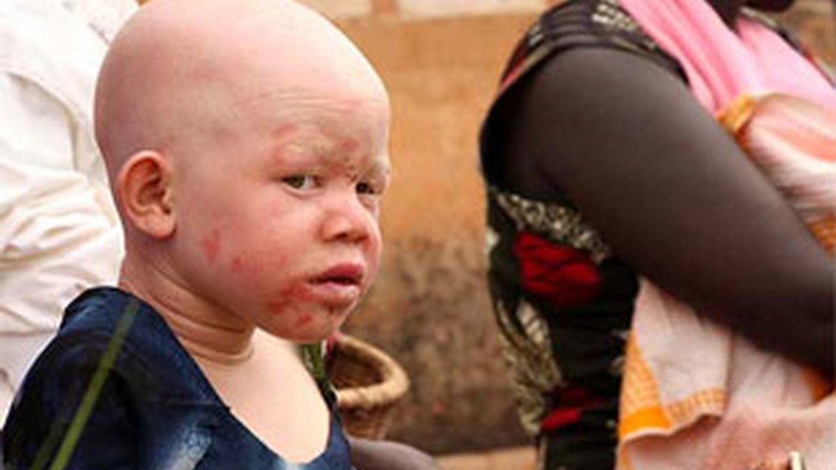 Imagen de archivo de un niño albino africano. Foto: EFE.