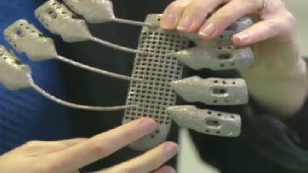 Un tórax a medida con una impresora 3D