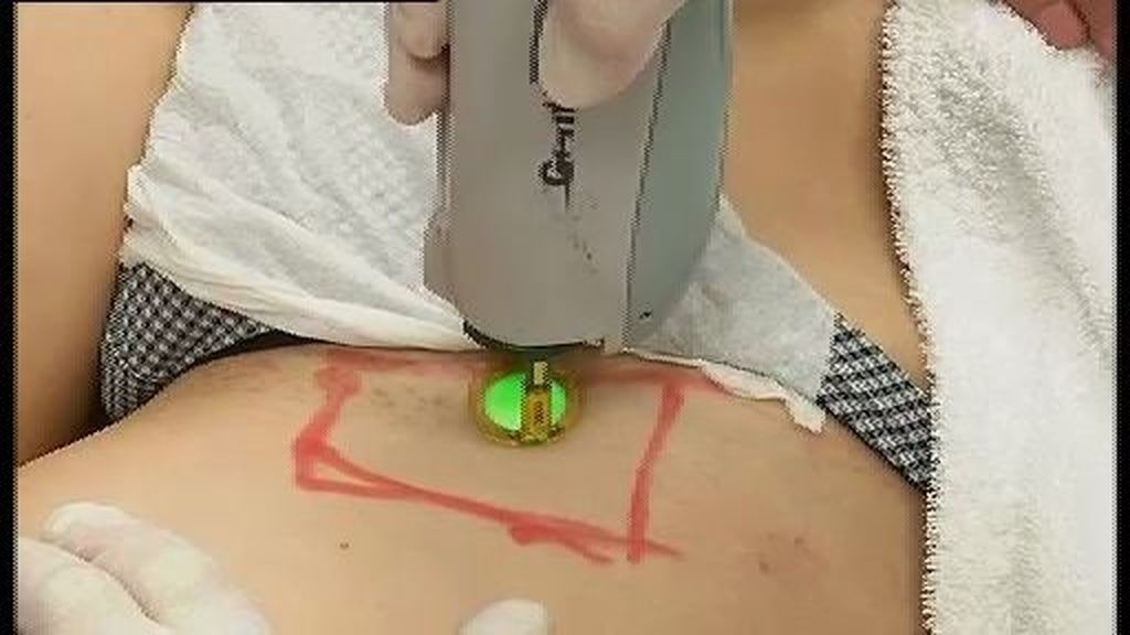 La depilación integral favorece las enfermedades de transmisión sexual