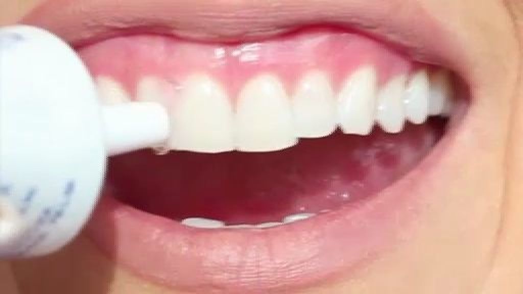 Blancorexia, la obsesión por los dientes blancos