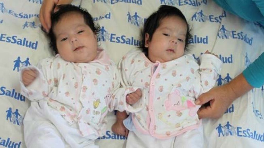 Separan con éxito a unas siamesas en Perú