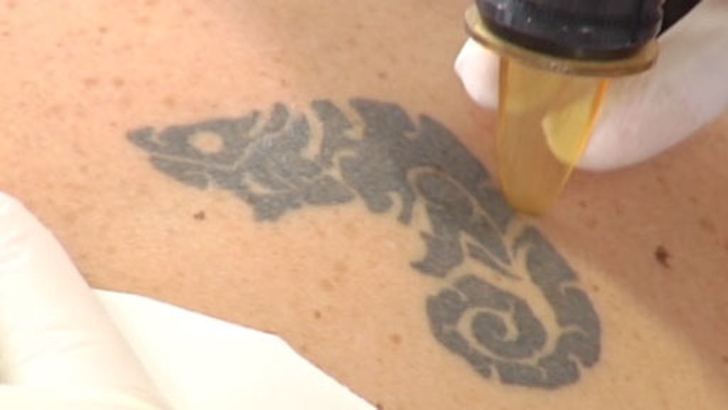 La demanda para eliminar tatuajes se dispara
