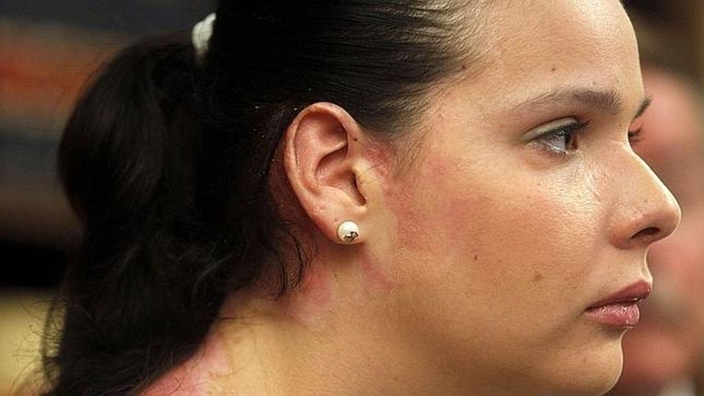 Saida Prieto pide ante el juez justicia por las quemaduras sufridas