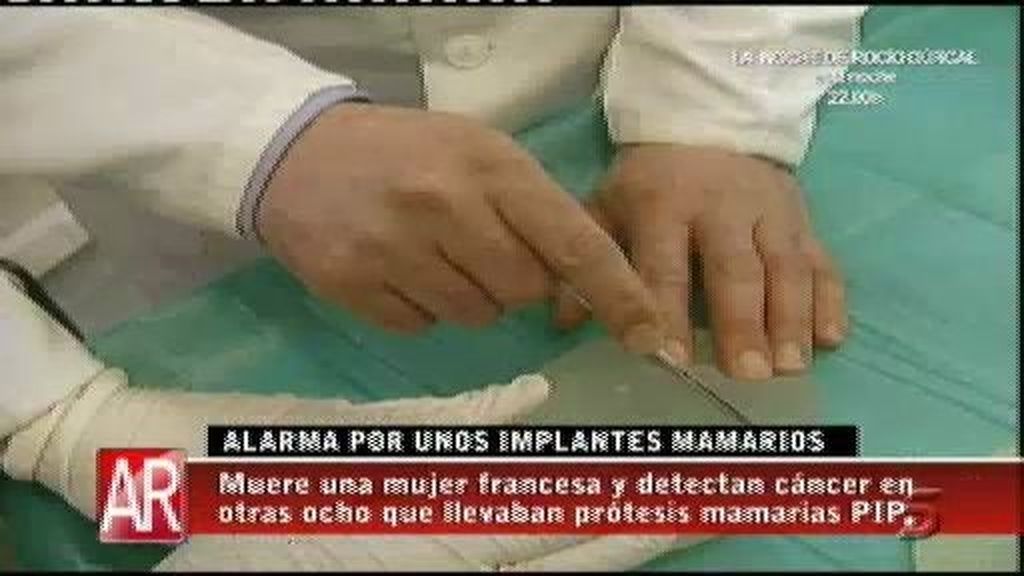 Alarma por unos implantes mamarios