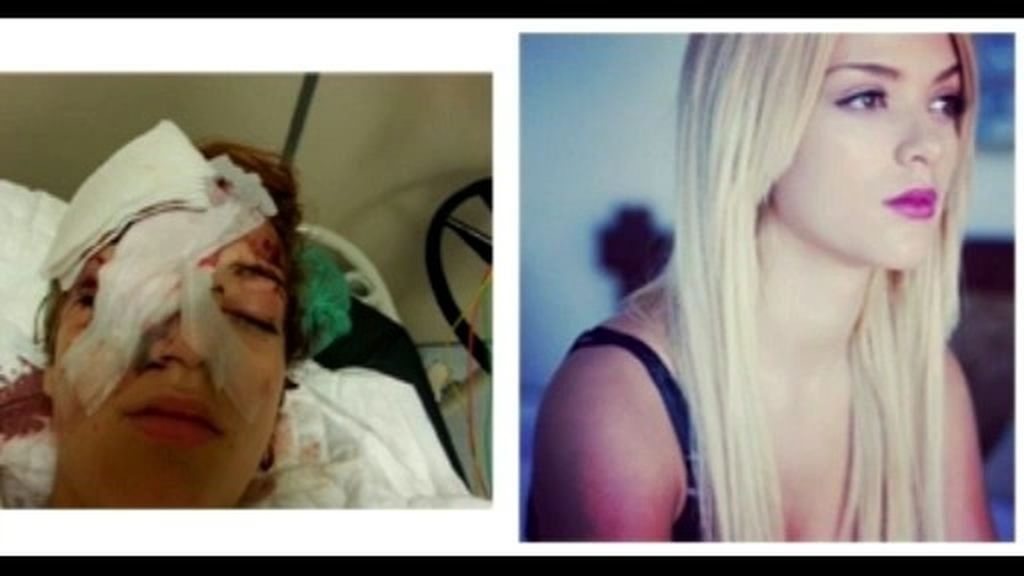Una joven recibe un botellazo en la cara y pierde un ojo