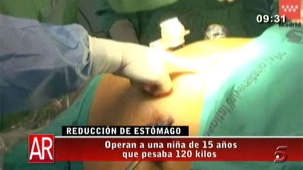 Reducción de estómago a una menor