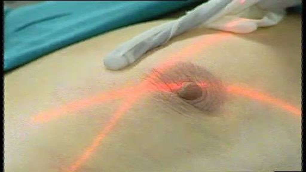 Mastectomía preventiva para evitar el cáncer de mama