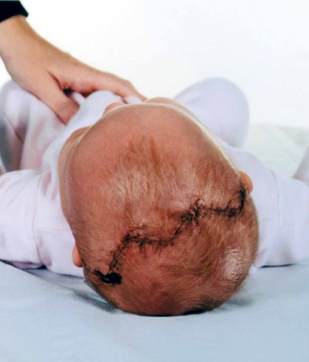 La 'niña milagro' a la que abrieron el cráneo para salvarla